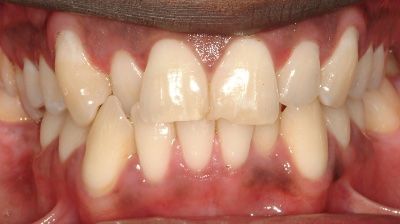 Anterior Tooth in Crossbite