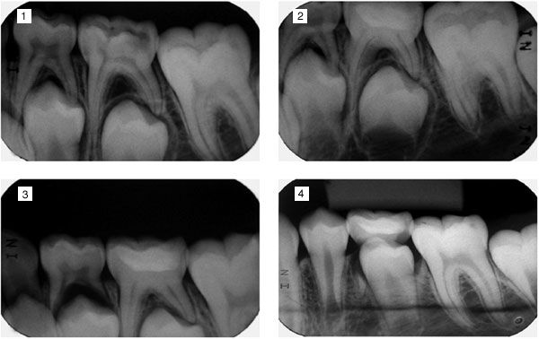 Erupting Tooth Series