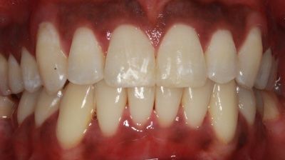 Crossbite Corrected after Invisalign Treatment
