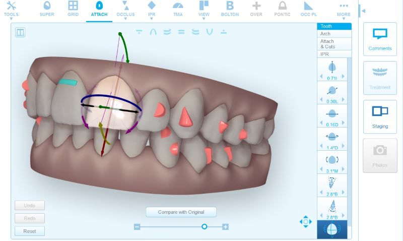 digital orthodontics for Invisalign