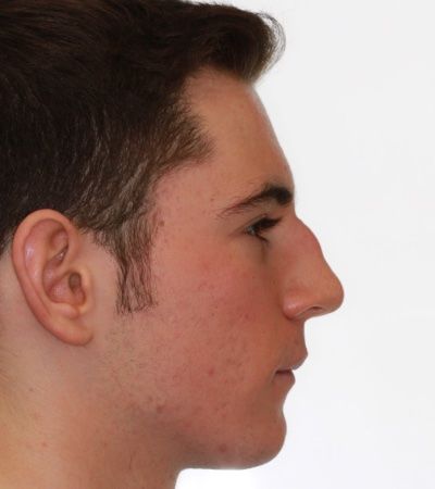Initial Facial Profile
