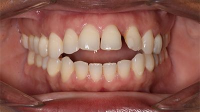 Antiya Teeth before Open bite correction