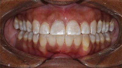 After Overjet and Crowding Treatment with Clear Braces