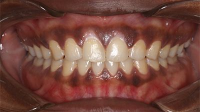 Spacing in teeth corrected