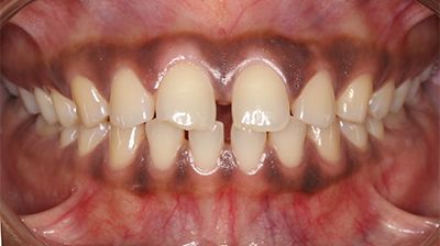 Anterior Tooth Spacing