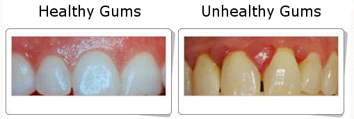 Healthy Gums and Unhealthy Gums