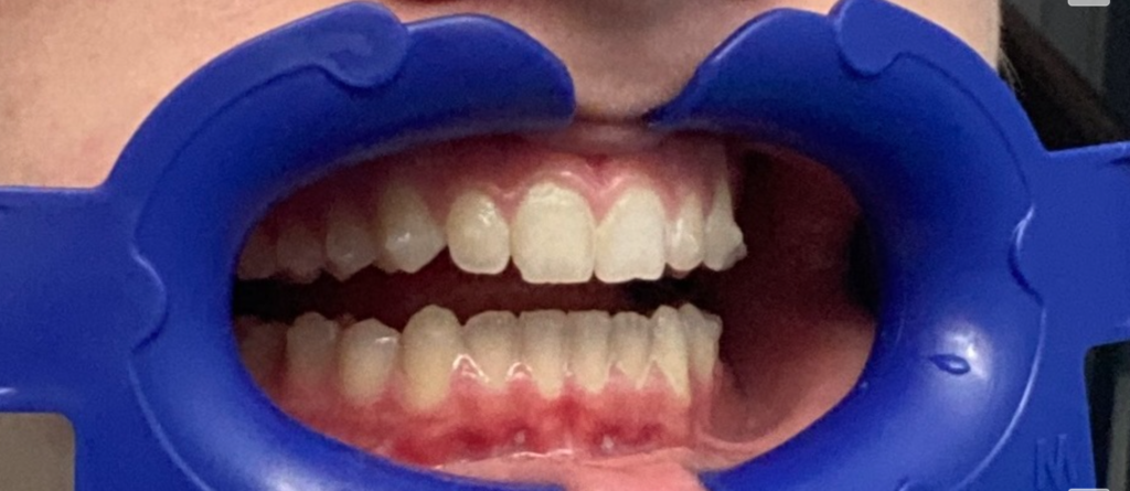 Aligners from right side