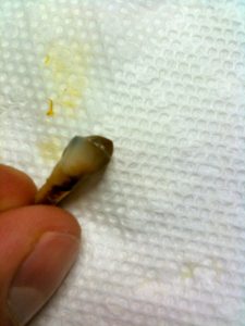 tooth in Diet Coke for 2-Weeks